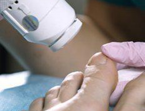 Laser Toenail Fungus Treatment